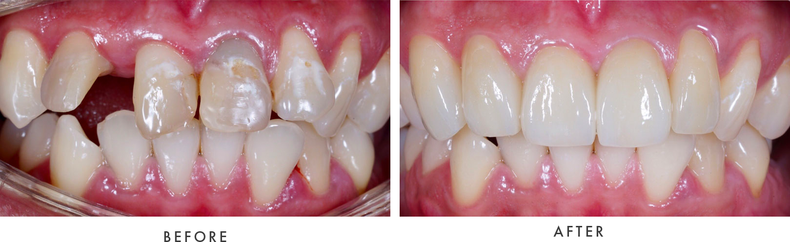 before and after dental procedure