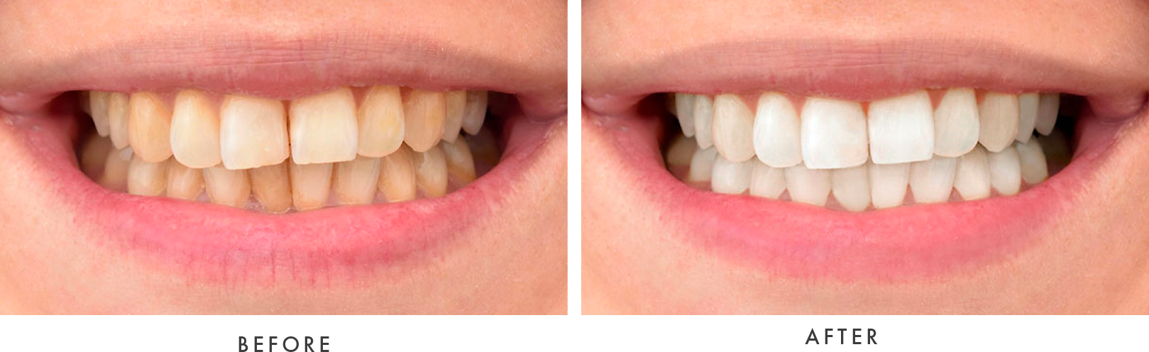 before and after dental procedure