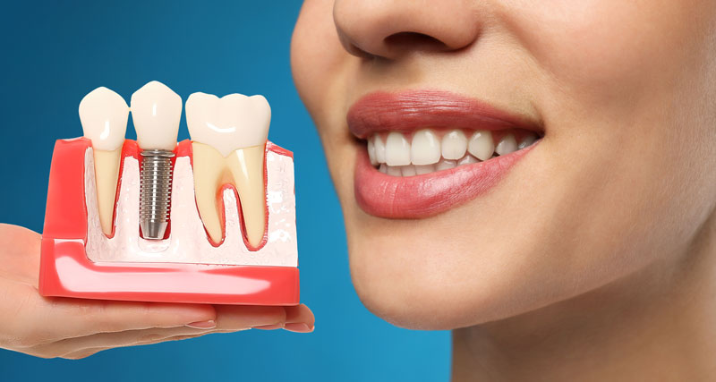 Exploring Your Options for Replacing a Missing Tooth: The Advantage of Dental Implants